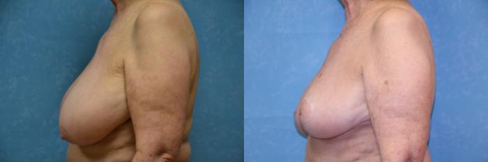 Before & After Breast Reduction Case 520 Left Side View in Toledo, Ohio