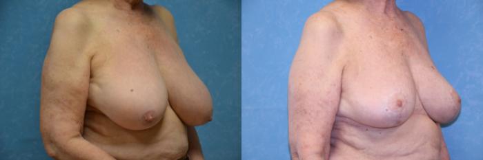 Before & After Breast Reduction Case 520 Right Oblique View in Toledo, Ohio