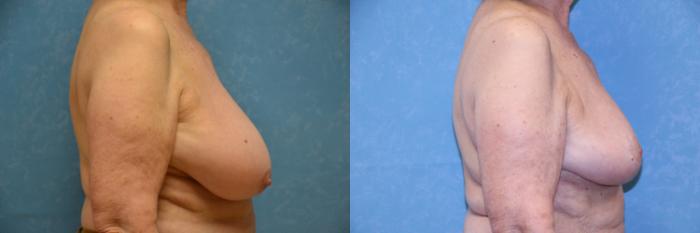 Before & After Breast Reduction Case 520 Right Side View in Toledo, Ohio