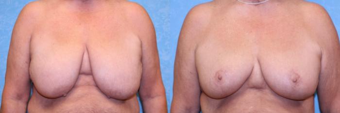 Before & After Breast Reduction Case 523 Front View in Toledo, Ohio