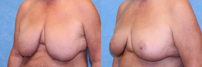 Before & After Breast Reduction Case 523 Left Oblique View in Toledo, Ohio