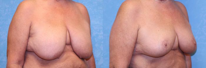 Before & After Breast Reduction Case 523 Right Oblique View in Toledo, Ohio
