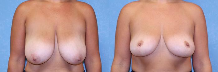 Before & After Breast Reduction Case 533 Front View in Toledo, Ohio