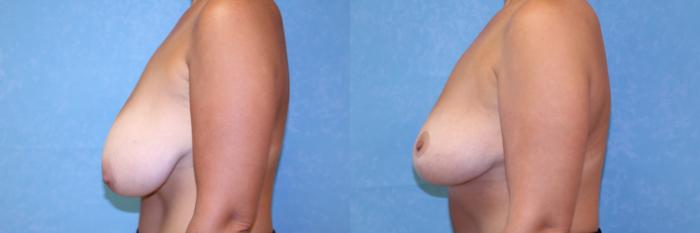 Before & After Breast Reduction Case 533 Left Side View in Toledo, Ohio