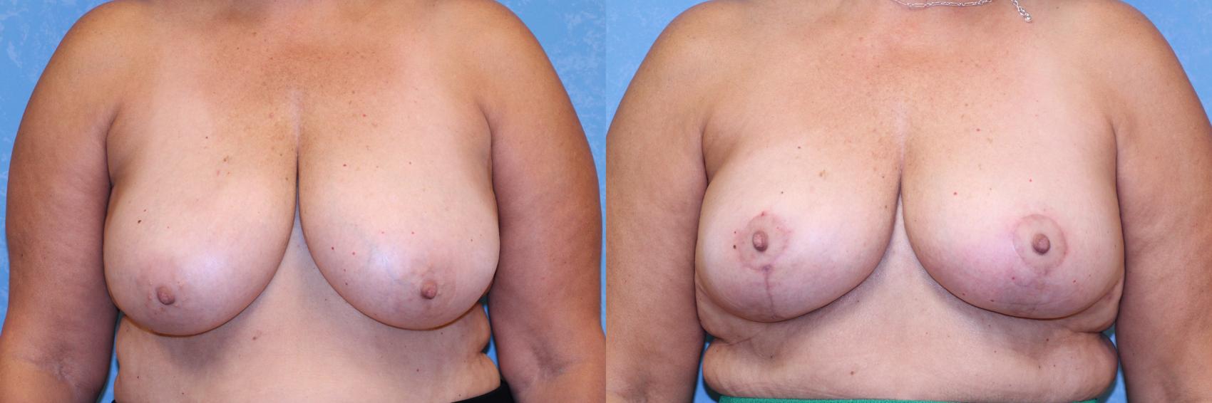 Before & After Breast Reduction Case 562 Front View in Toledo, Ohio