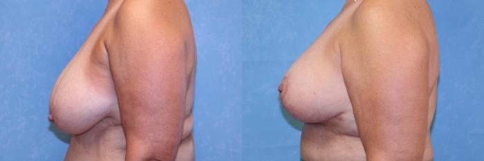 Before & After Breast Reduction Case 562 Left Side View in Toledo, Ohio