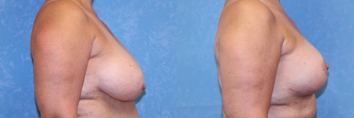 Before & After Breast Reduction Case 562 Right Side View in Toledo, Ohio