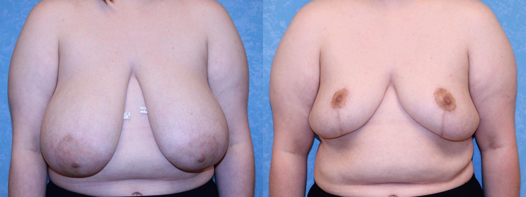 Before & After Breast Reduction Case 576 Front View in Toledo, Ohio