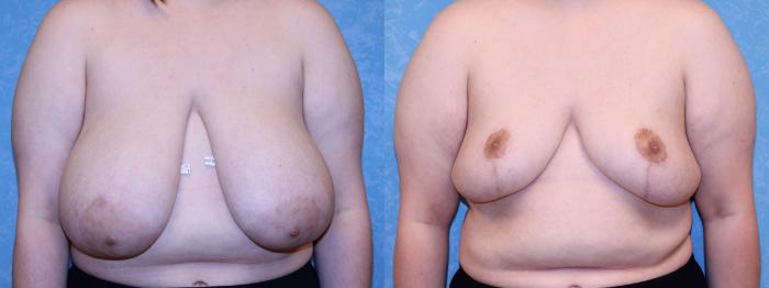 Before & After Liposuction Case 576 Front View in Toledo, Ohio