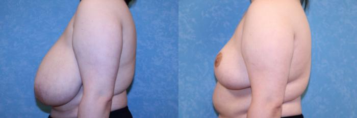 Before & After Breast Reduction Case 576 Left Side View in Toledo, Ohio
