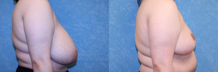 Before & After Breast Reduction Case 576 Right Side View in Toledo, Ohio