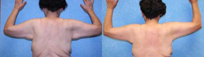 Before & After Breast Reduction Case 578 Back View in Toledo, Ohio