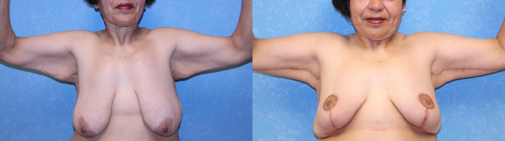 Before & After Breast Reduction Case 578 Front View in Toledo, Ohio