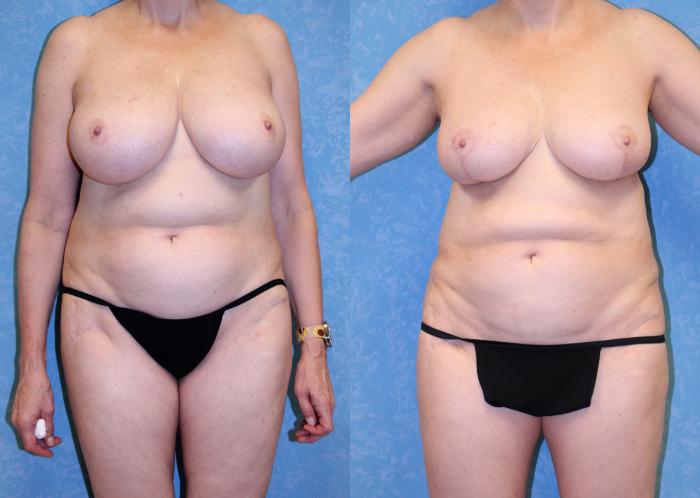 Before & After Breast Reduction Case 579 Front View in Toledo, Ohio