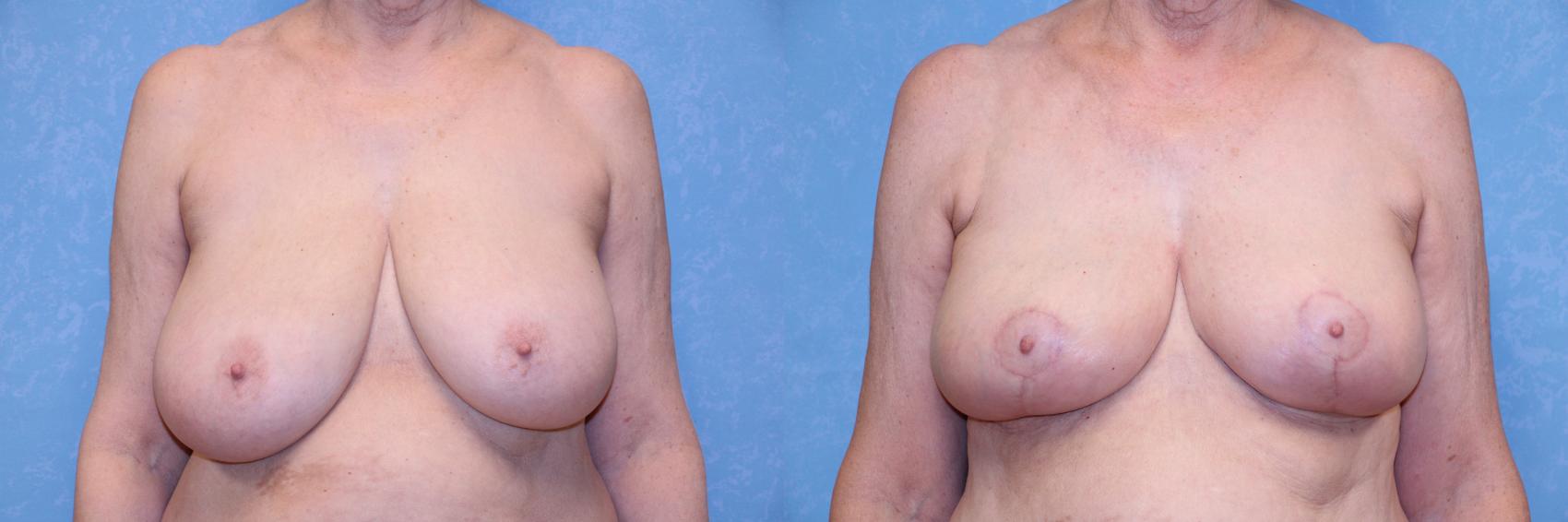 Before & After Liposuction Case 581 Front View in Toledo, Ohio