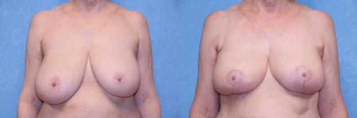 Before & After Liposuction Case 581 Front View in Toledo, Ohio