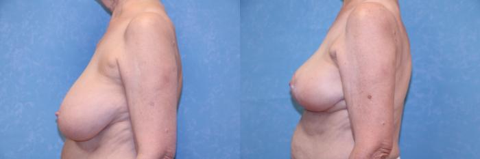 Before & After Liposuction Case 581 Left Side View in Toledo, Ohio