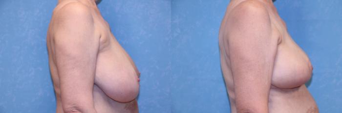 Before & After Liposuction Case 581 Right Side View in Toledo, Ohio