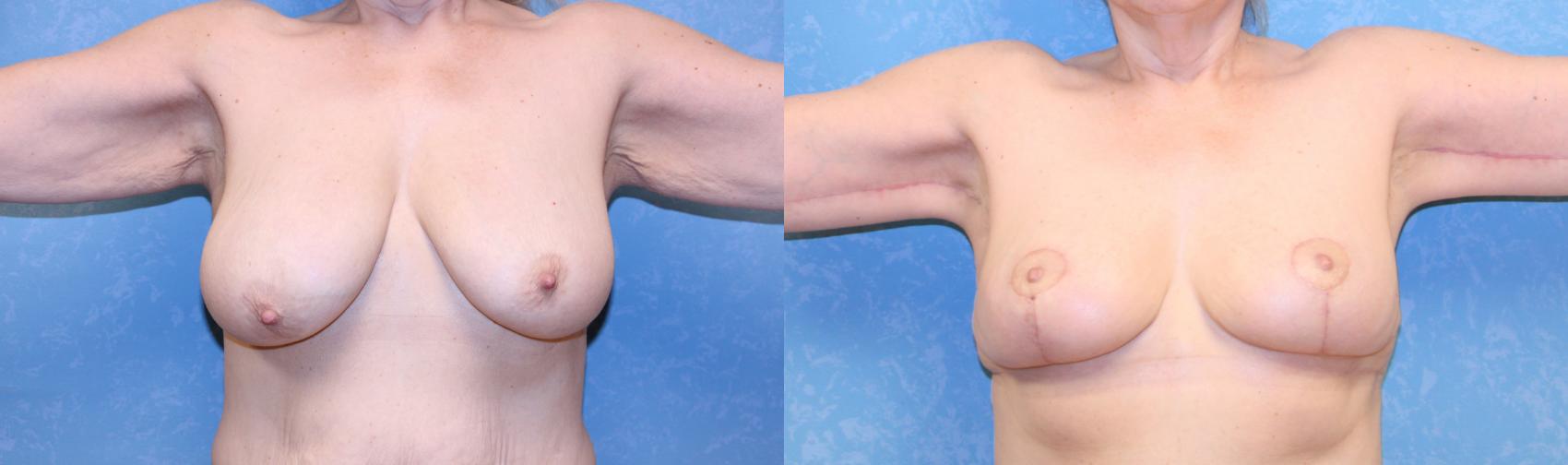 Before & After Breast Reduction Case 586 Front View in Toledo, Ohio