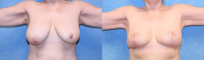 Before & After Breast Reduction Case 586 Front View in Toledo, Ohio