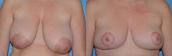 Before & After Breast Reduction Case 59 View #1 View in Toledo, Ohio