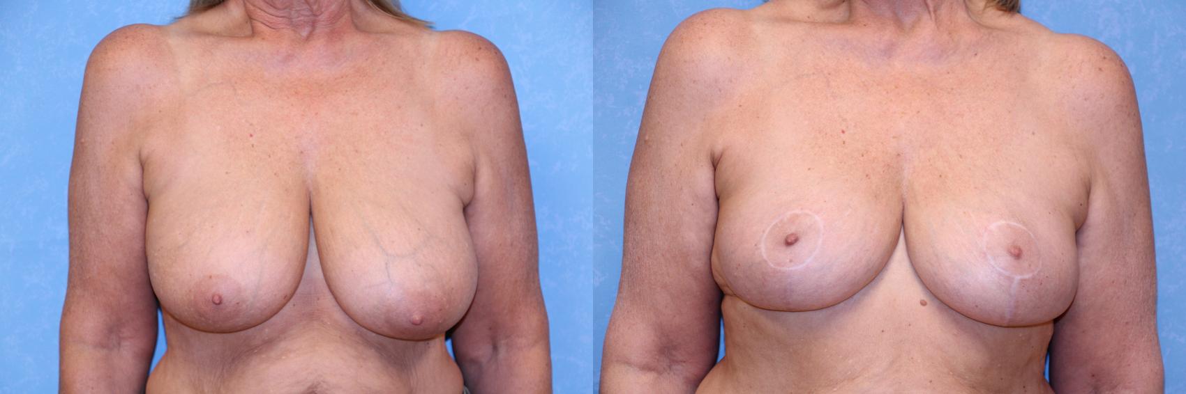 Before & After Breast Reduction Case 596 Front View in Toledo, Ohio