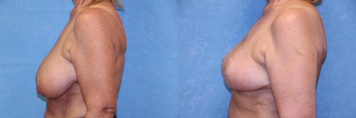 Before & After Breast Reduction Case 596 Left Side View in Toledo, Ohio
