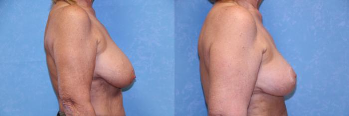 Before & After Breast Reduction Case 596 Right Side View in Toledo, Ohio