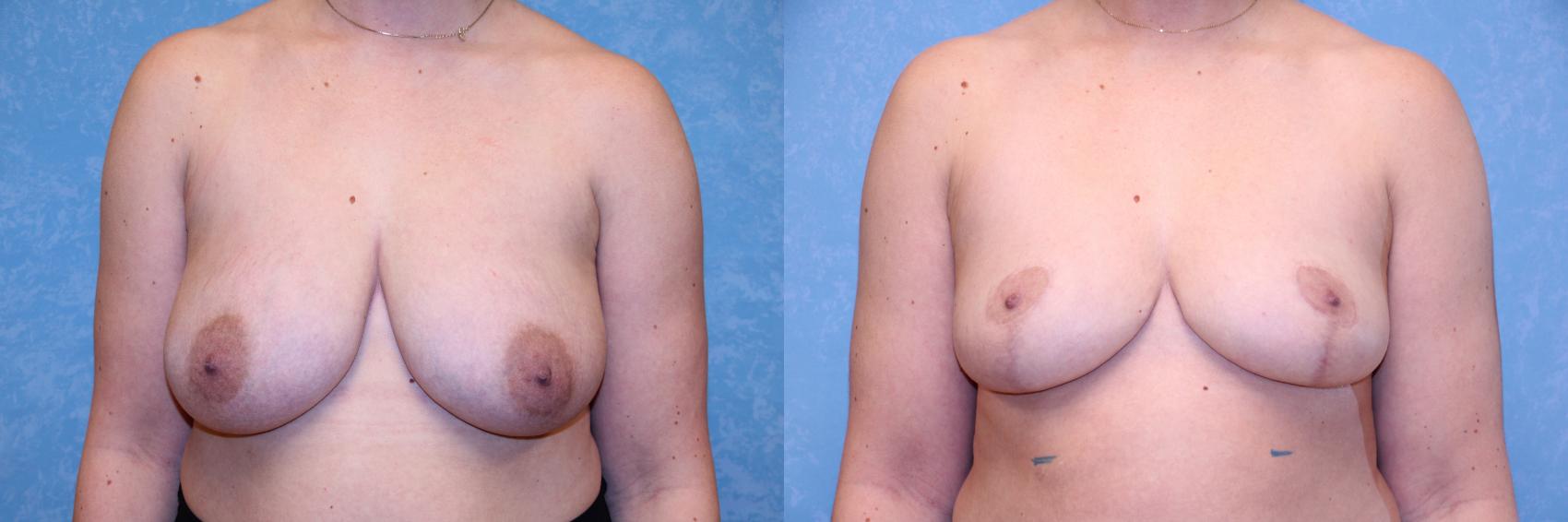 Before & After Breast Reduction Case 602 Front View in Toledo, Ohio