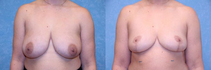 Before & After Breast Reduction Case 602 Front View in Toledo, Ohio
