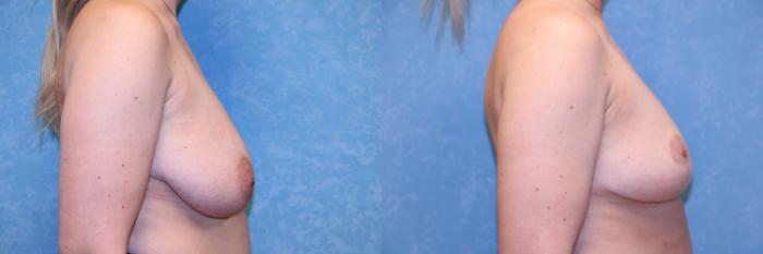 Before & After Breast Reduction Case 602 Right Side View in Toledo, Ohio