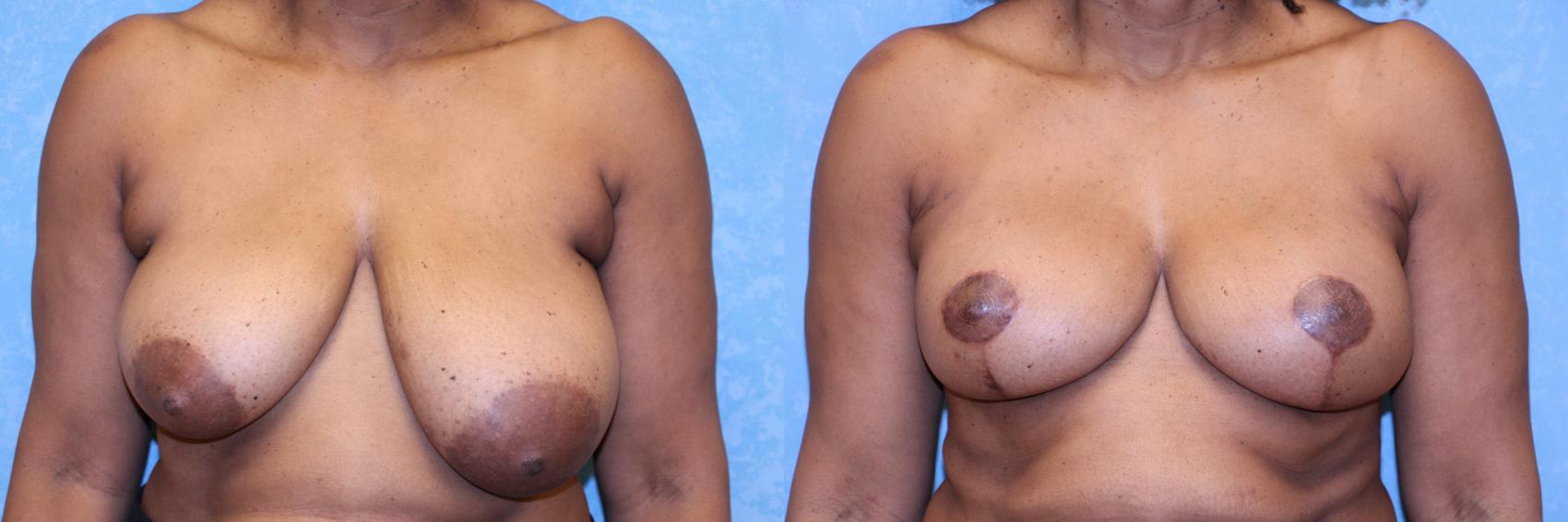 Before & After Breast Reduction Case 605 Front View in Toledo, Ohio