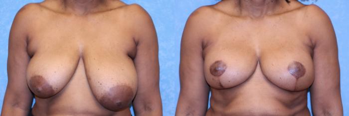 Before & After Breast Reduction Case 605 Front View in Toledo, Ohio