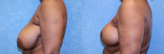 Before & After Breast Reduction Case 605 Left Side View in Toledo, Ohio