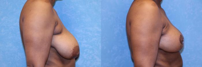 Before & After Breast Reduction Case 605 Right Side View in Toledo, Ohio