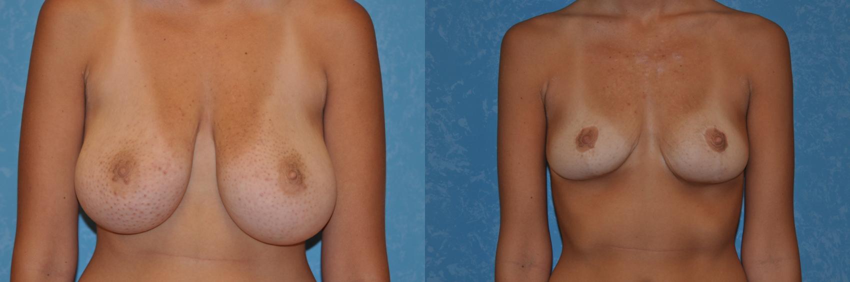 Before & After Breast Reduction Case 88 View #1 View in Toledo, Ohio