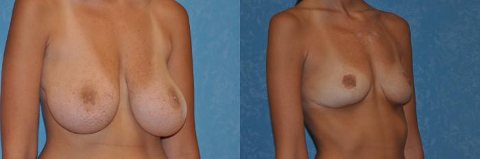 Before & After Breast Reduction Case 88 View #3 View in Toledo, Ohio
