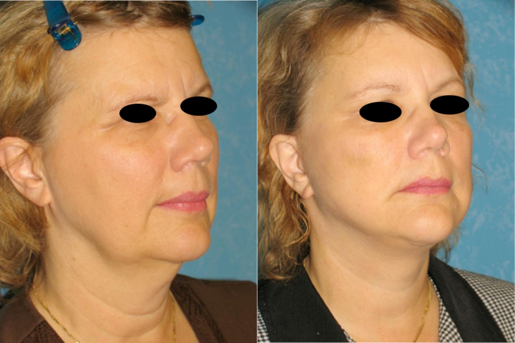 Before & After Brow Lift Case 115 View #1 View in Toledo, Ohio