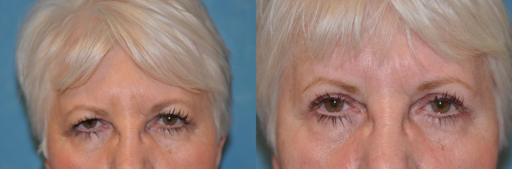 Before & After Brow Lift Case 252 View #1 View in Toledo, Ohio