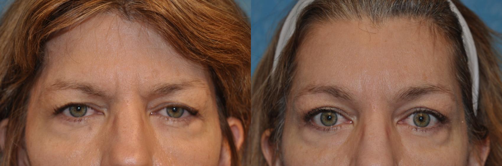 Before & After Brow Lift Case 323 View #1 View in Toledo, Ohio