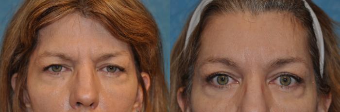 Before & After Brow Lift Case 323 View #1 View in Toledo, Ohio
