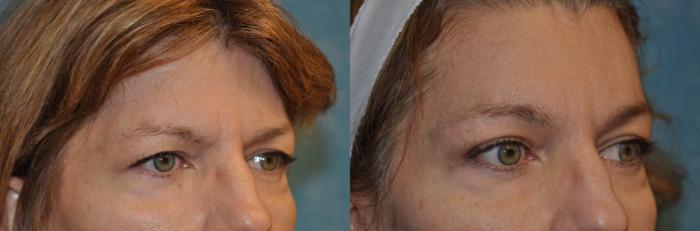 Before & After Brow Lift Case 323 View #2 View in Toledo, Ohio