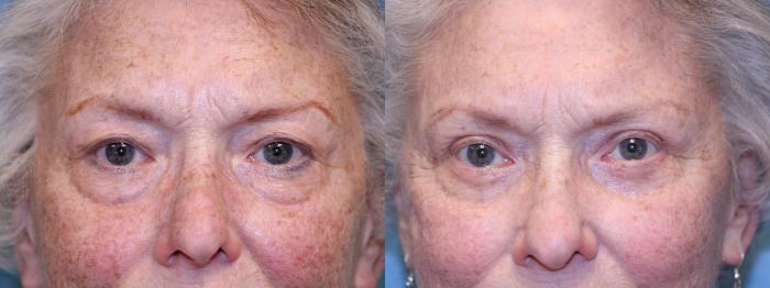 Before & After Eyelid Lift Case 452 Front View in Toledo, Ohio