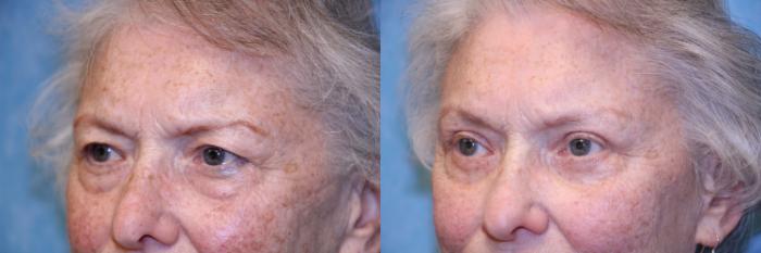Before & After Eyelid Lift Case 452 Left Oblique View in Toledo, Ohio