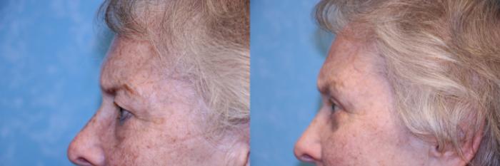 Before & After Brow Lift Case 452 Left Side View in Toledo, Ohio