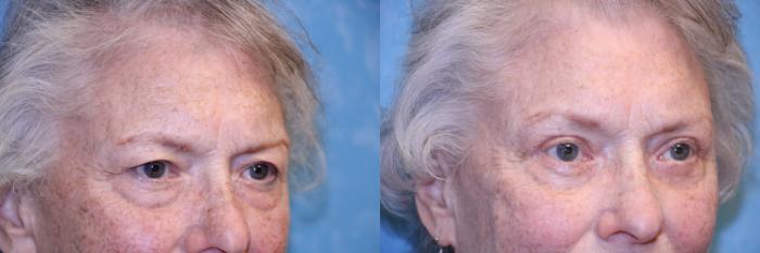Before & After Brow Lift Case 452 Right Oblique View in Toledo, Ohio