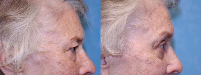 Before & After Eyelid Lift Case 452 Right Side View in Toledo, Ohio