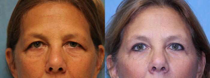 Before & After Eyelid Lift Case 457 Front View in Toledo, Ohio