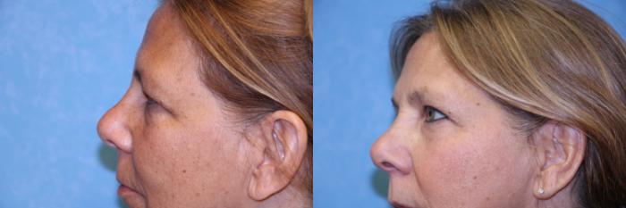 Before & After Eyelid Lift Case 457 Left Side View in Toledo, Ohio