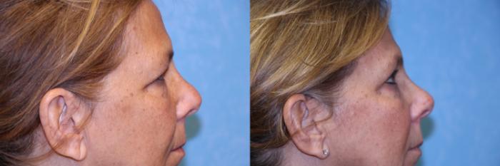 Before & After Brow Lift Case 457 Right Side View in Toledo, Ohio